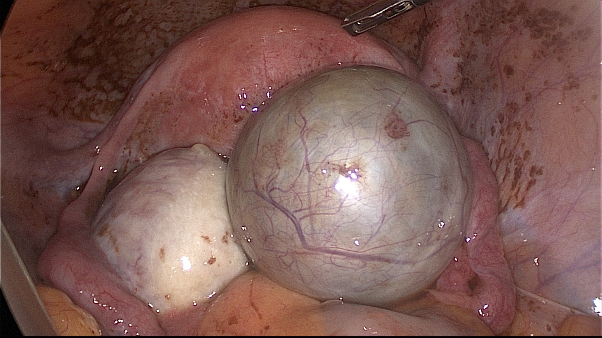 Эндометриоидные кисты обоих яичников в сочетании с рубцово-спаечным процессом
