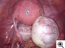 Эндометриоидные кисты 
яичника