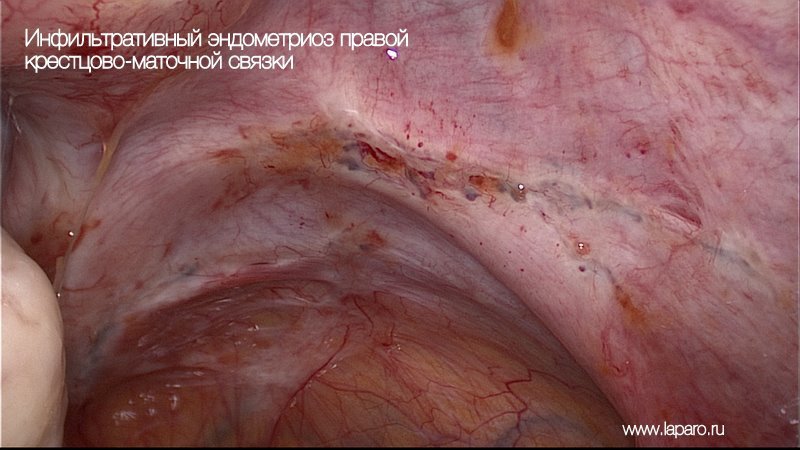 Инфильтративный эндометриоз крестцово-маточной связки